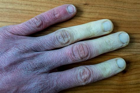 frstbite_iah|First frostbite treatment approved by FDA .